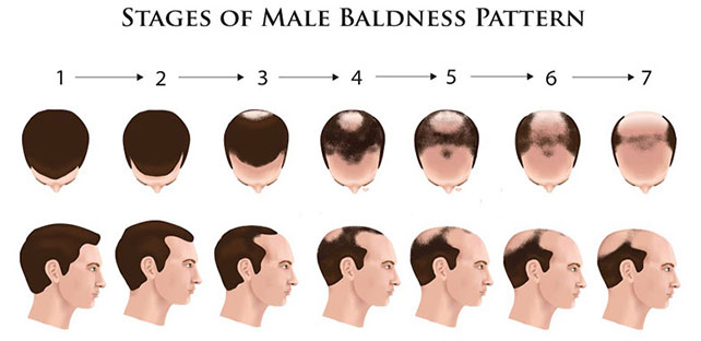 Why Hair Loss in Men, Causes Of Hair Loss in Men